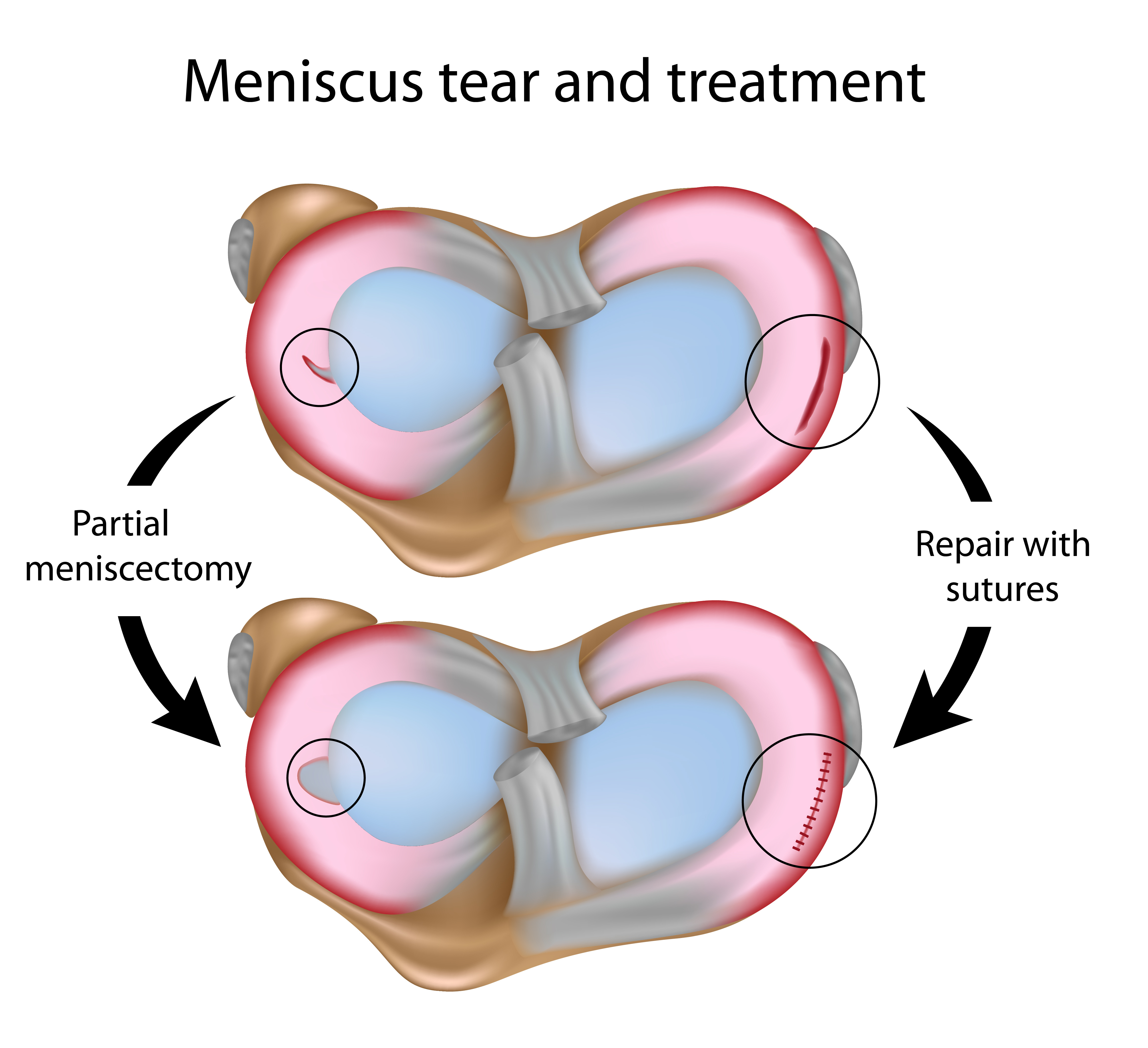 Meniscus Tear Treatment