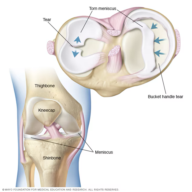 Meniscus Tear Repair Surgery