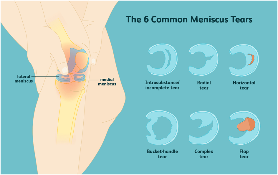 Meniscus Tear Procedure