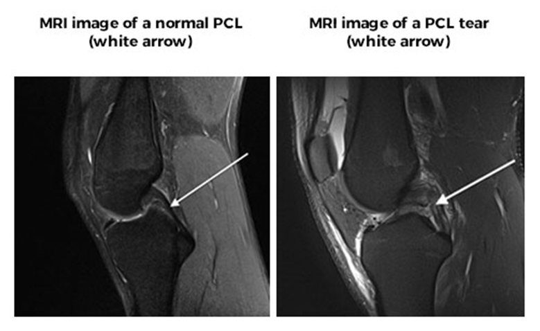 PCL Surgery