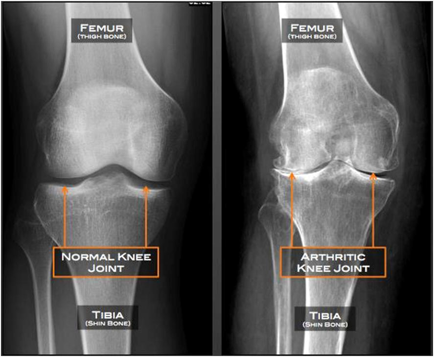 Knee Replacement Benefits