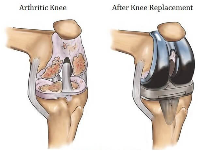 Preparation for Knee Surgery