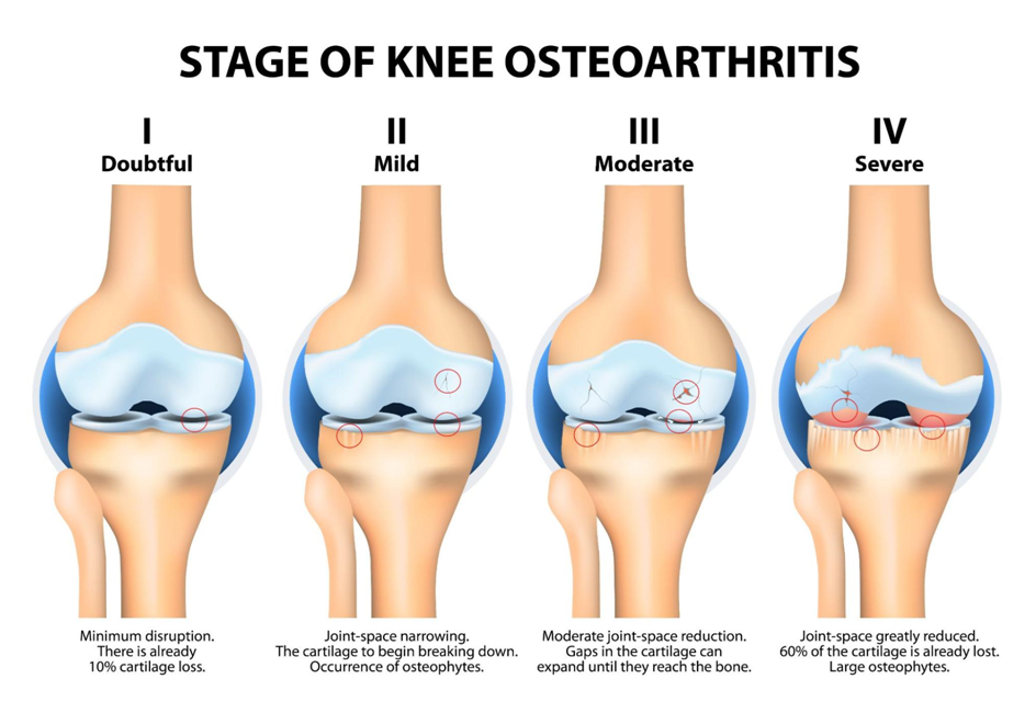 Symptoms of Knee Osteoarthritis