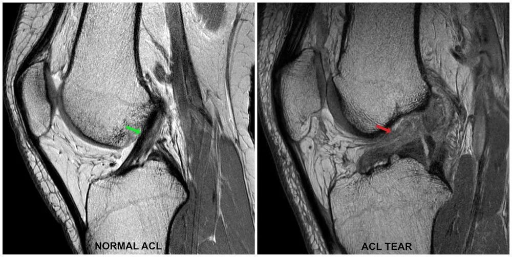 ACL Recovery